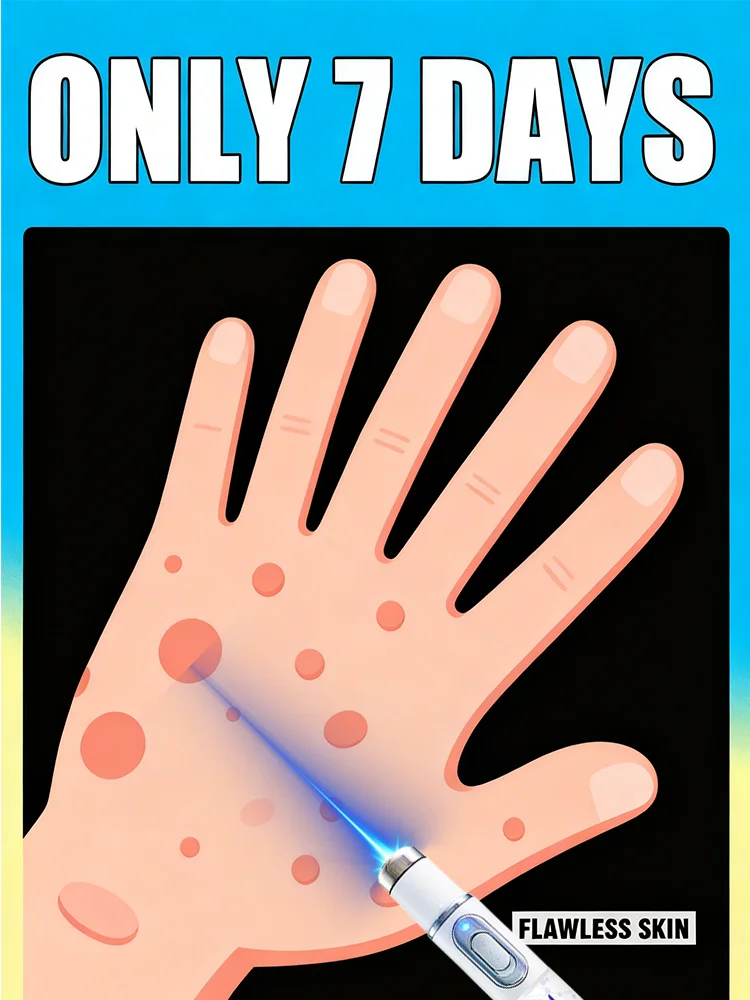 

25 hot selling Blue Laser Solve Wart Tool