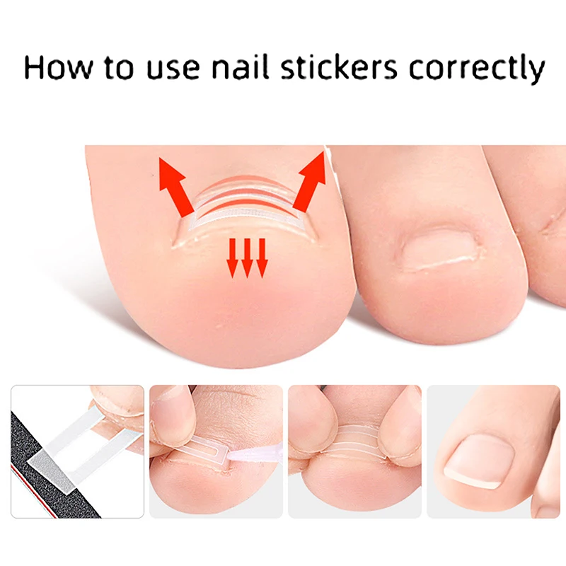 10 pcs Alien Ingrown Toenail Corrective Clip Strips Nail Treatment Elastic Corrective Clip Bracket Foot Care Tools