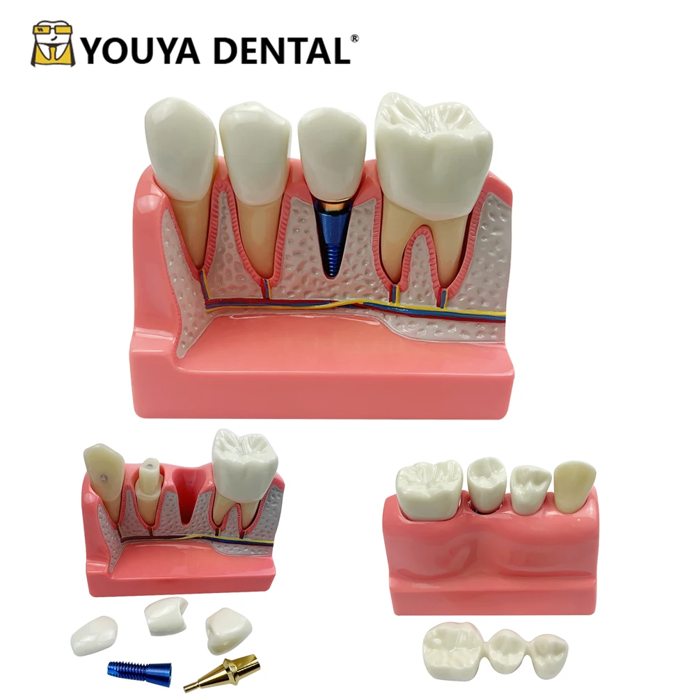 Dental Implant Teeth Model 4 Times Dentistry Teach Implant Analysis Crown Bridge Removable Model Dentist Demonstration Tool