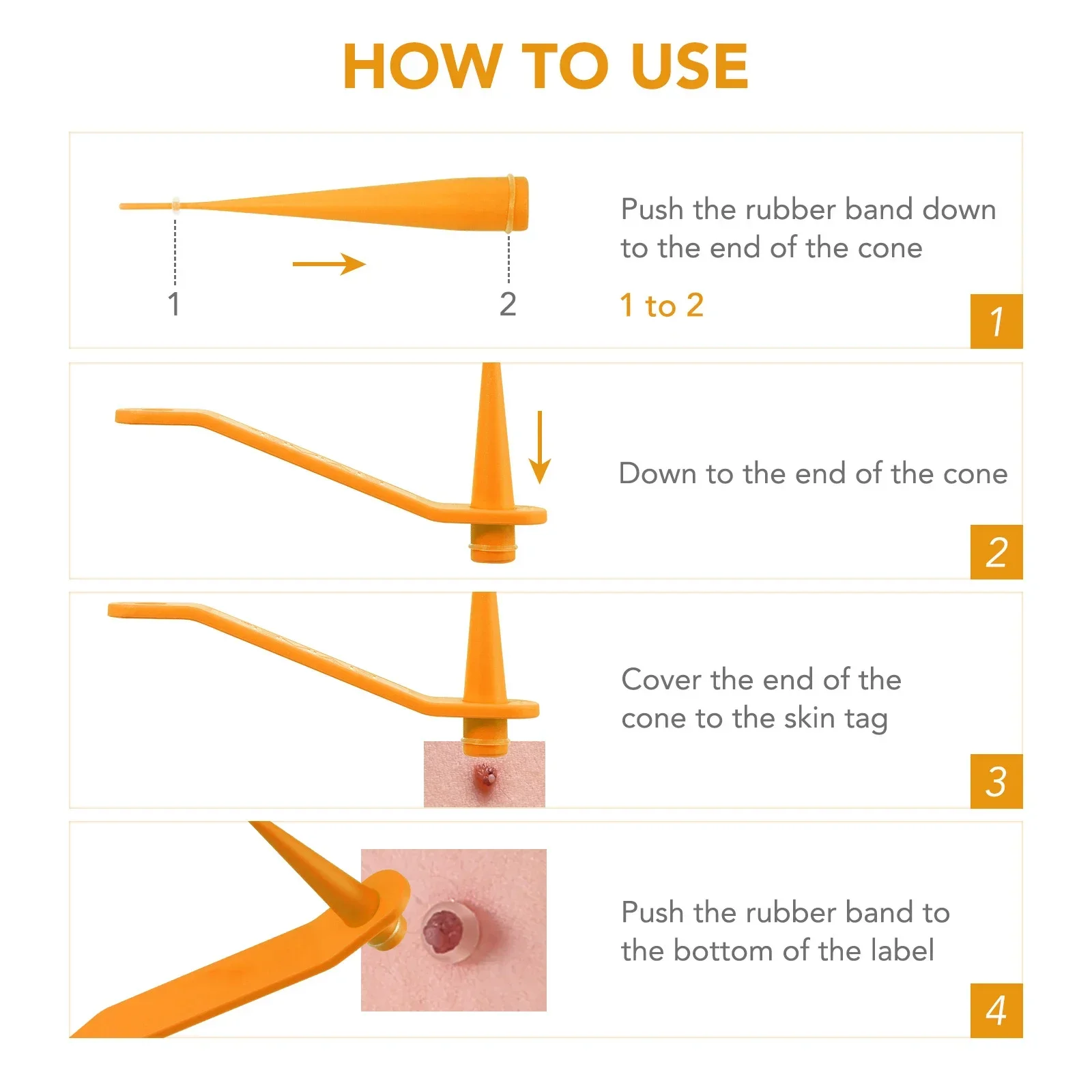 Eenvoudige gereedschapsset voor het verwijderen van wratten Huidtag Verwijderingsgereedschap Gemakkelijk schoon te maken Huidverzorgingshulpmiddel Huidtagverwijdering Verzorgingsproducten