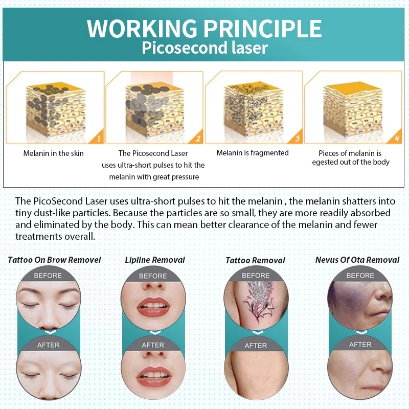 เครื่องลบรอยสักเลเซอร์แบบพกพา755Nm 1320Nm 1064Nm 532Nm ร้านเสริมสวยใหม่