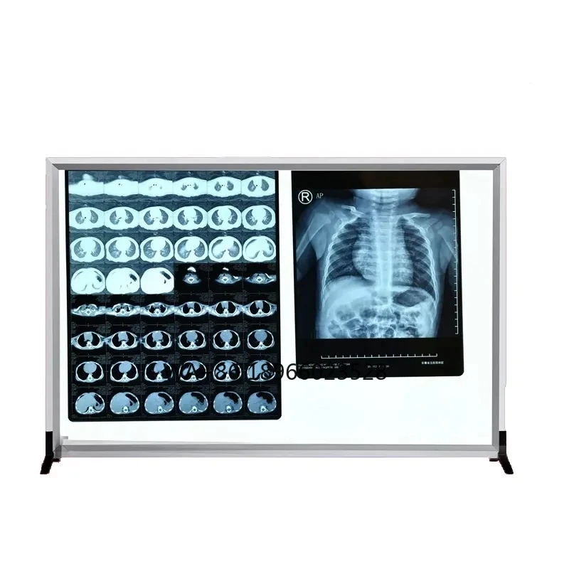 Medical portable SIngle double linked hospital Viewer Led X-ray film Viewer observation lamp viewing light box