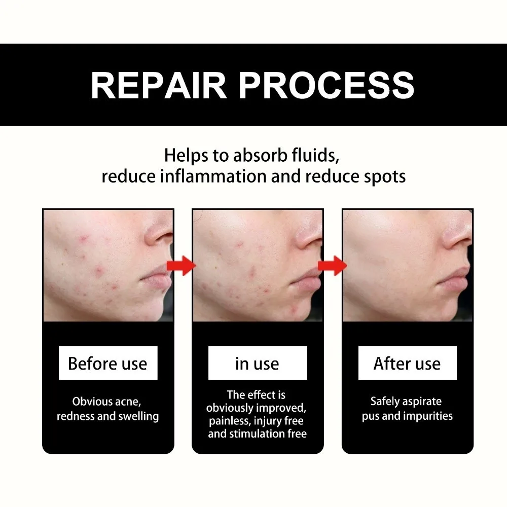 Alcohol Free Black Star Pimples Patch Non Irritating Ultrathin Hydrocolloid Pimples Patch Gentle Formula Beauty Face Patch