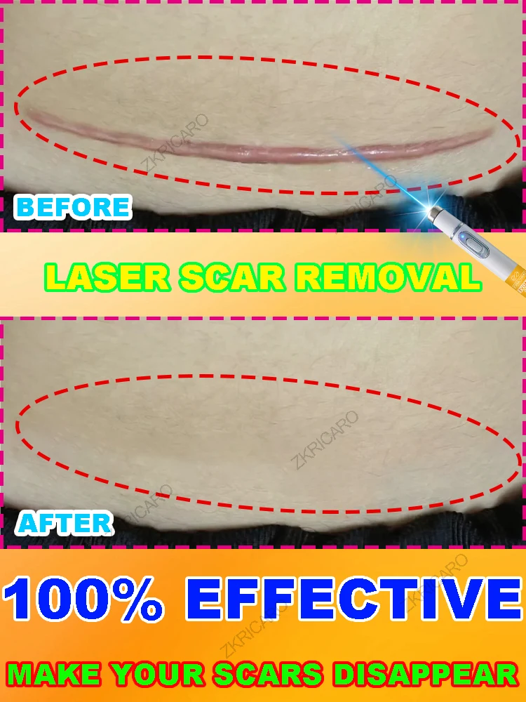 

Laser irradiation, so you don't have to worry about scars