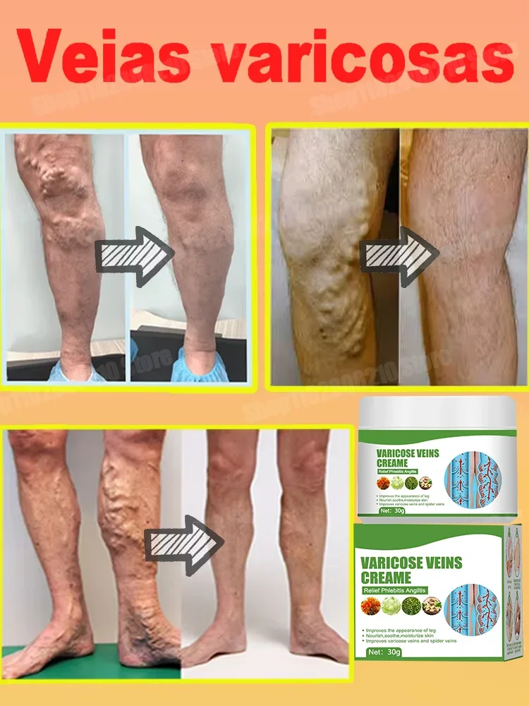 100% effective varicose vein remover, effective vasculitis relief, varicose vein removal cream