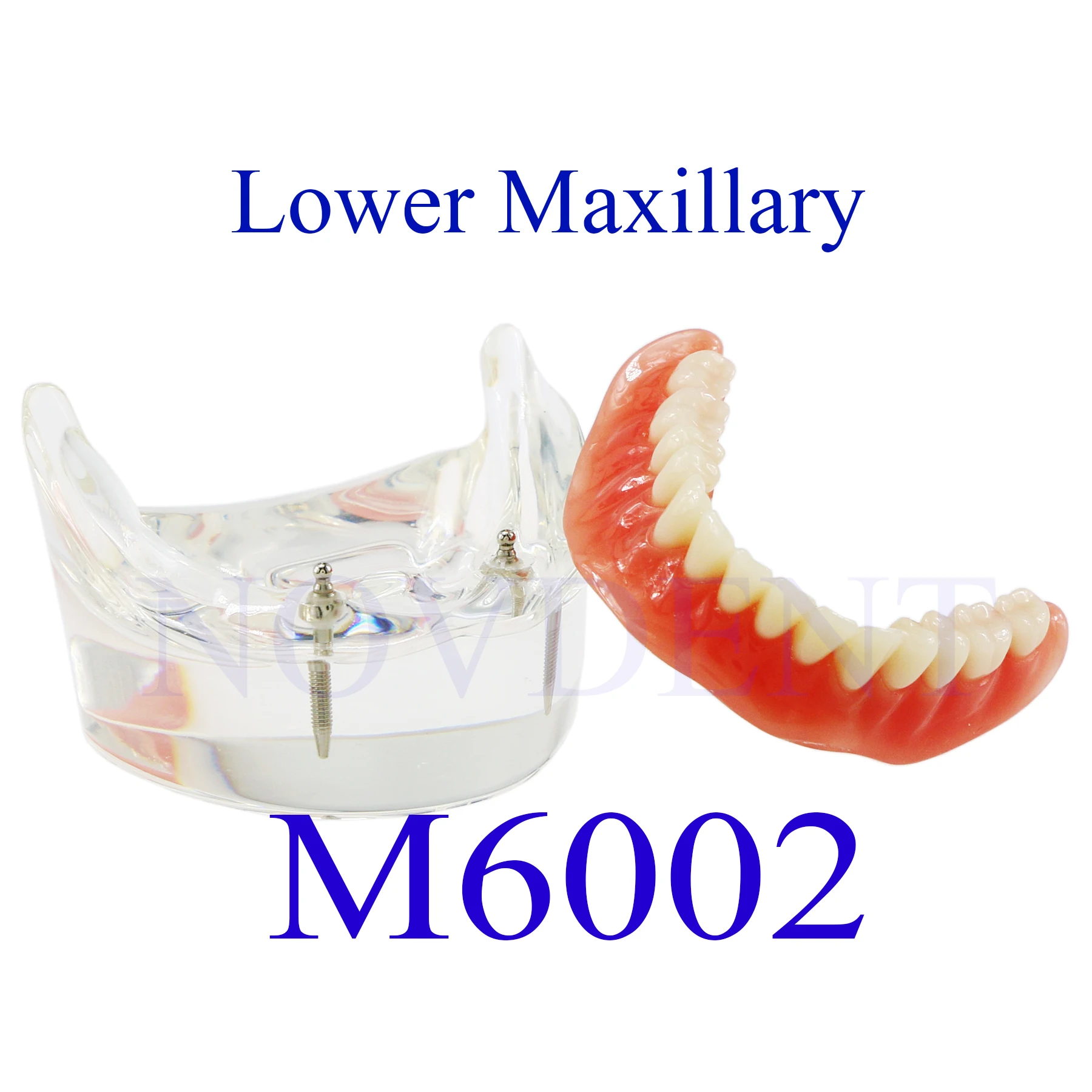 Dental dolna szczęka 2 implanty Model odbudowy Overdenture Model 2 implanty mosty edukacja badania nauczanie Student M6002