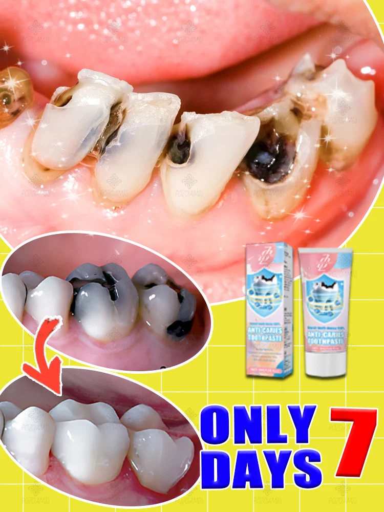 Anti-caries toothpaste whitens teeth