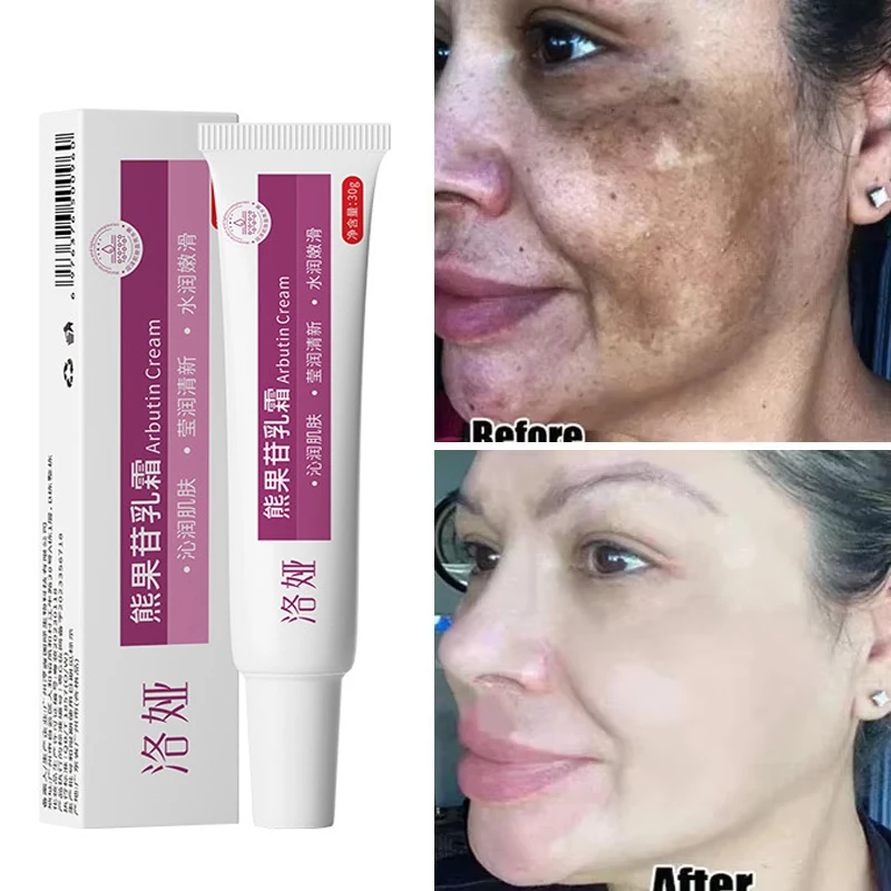 Freckle Whiten Cream Effective Removing Spot Eliminate Brown Stain Melasma Melanin Blemishes Lighten Moisturiser Face Skin Care