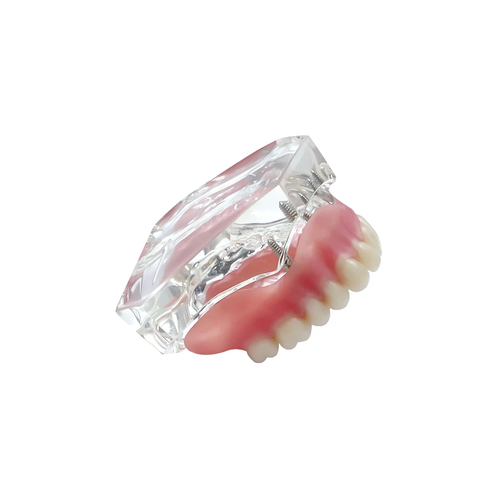 4 Implants Dental Implant Teeth Model Transparent Overdenture Model With Restoration Bridge For Education Teaching Studying Demo