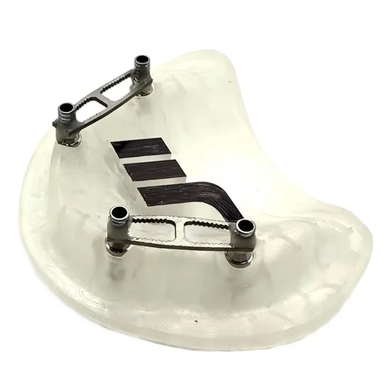 Dental Implant Impression Splinting Bar Dental Lab Fits Straumann & Nobel Temp Bridge & Multi-Implant Analog Connection 10Pcs