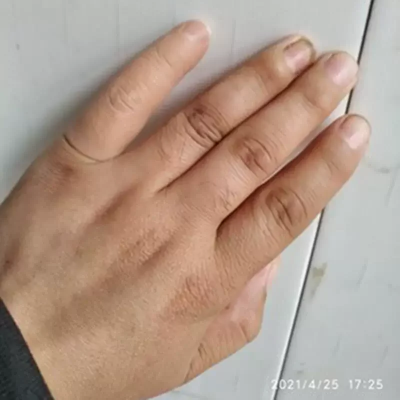 Variant: little finger