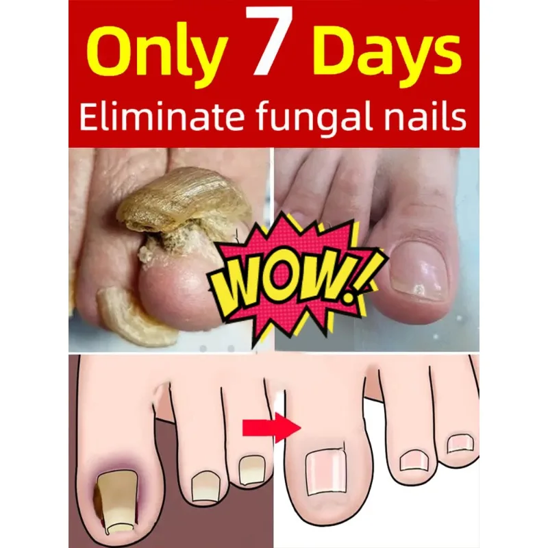

Nail Fungus Oil Soften Nail Treatment Oil for Weak Cracked Split Nails High Quality product
