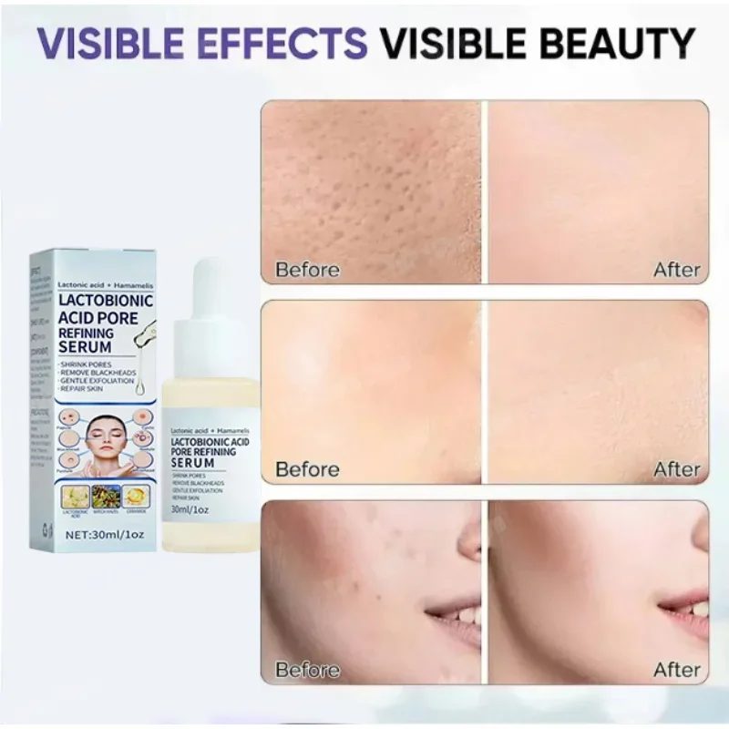 

South Korea develops 2025 latest facial pore shrinking essence, which can remove yellowing, brighten and fade acne marks