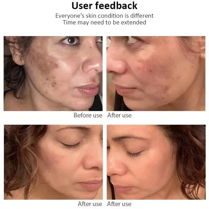 Crema sbiancante lentiggine rimuovi Melasma pelle ferma dissolvenza lentiggini riparazione melanina illumina idratante prodotti Anti-età per la cura della pelle