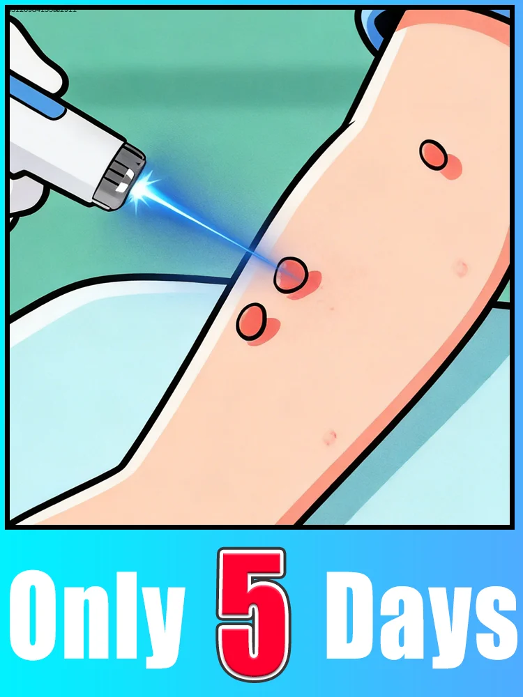 

Лазер второго поколения, который раскупается как горячие пирожки, избавляет от всех бородавок за 7 дней.