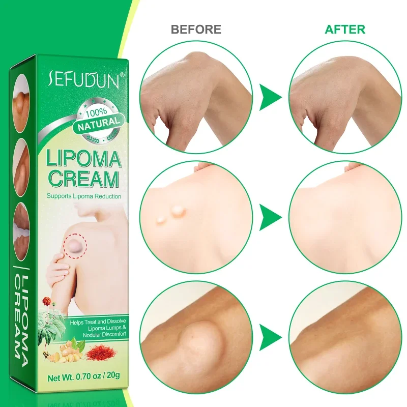 Lipoma Treatment Herbal Plaster Pain Relief Ointment Multiple Anti-Tumor Peeling Fat Mass Remover Cream Health Care Products