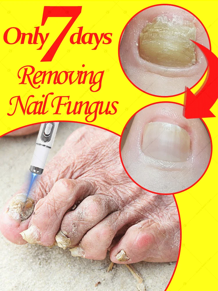 

Say goodbye to onychomycosis, no recurrence, no damage to nails.