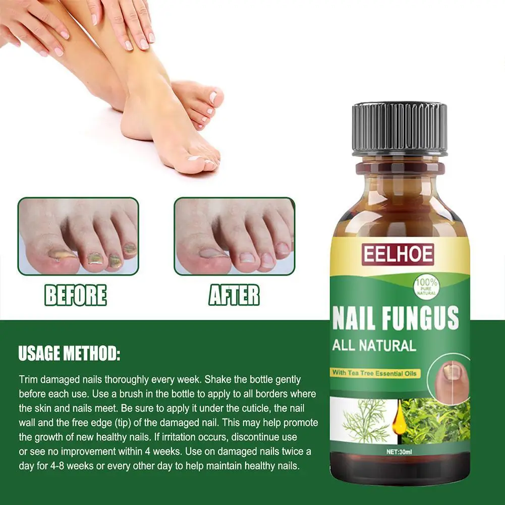 Nail Fungal Treatment Care Essence Nail Foot Whitening Removal Paronychia Anti Infection Gel Fungus Nails Onychomycosis K3M7