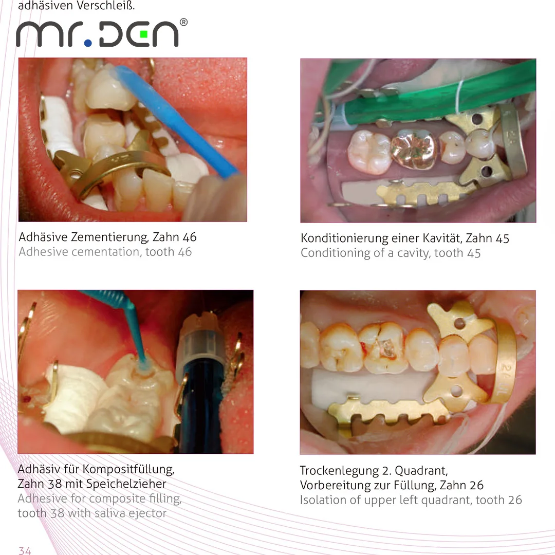 مشبك KKD الجديد وفقًا لعملية فني الأسنان الفردية Dr Landenberger Kentzler Kaschner #3