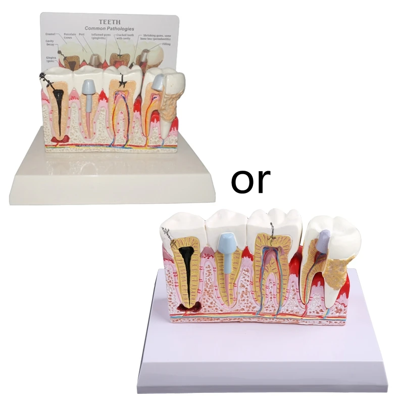 7x5.9x5.1in Patient Education&Explanation Model for Study Teach Decay Teeth Model Tooth Pathology Drop Shipping