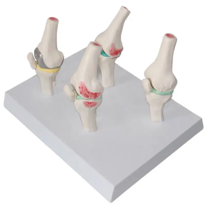 Osteoarthritis 4-stage Knee Arthritis Anatomy Model Lesion Joints Skeleton Medical Teaching Supplies