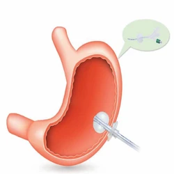 Zastosowanie medyczne jednorazowy silikonowy przezskórny endoskopowy zestaw kołków gastrostomijnych dla pacjenta z gastrostomią