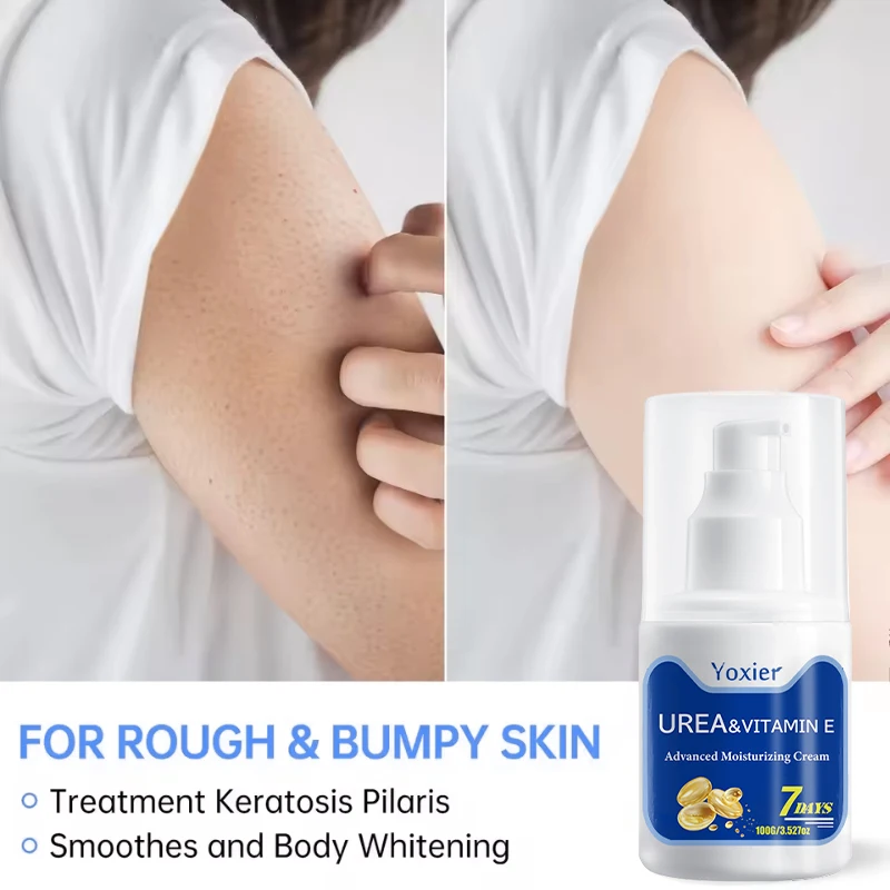 

100g Urea Removal Chicken Skin Moisturizing Cream Curing Keratosis Pilaris Repair Cream Smooth Skin Brighten Body Care