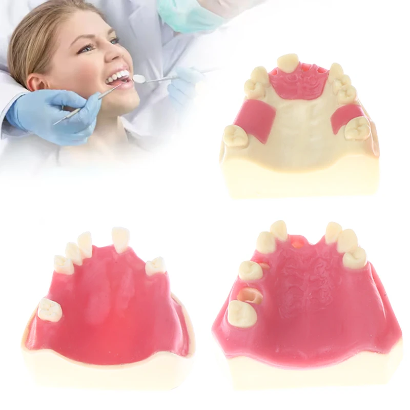 نموذج فقدان الأسنان زرع الأسنان طالب التدريب التدريب المعونة ممارسة نموذج العلوي الفك رفع يزرع استعادة نموذج مختبر