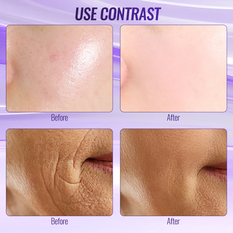 2025 Dual Mode Hoogfrequentiestaaf - Oranje (Argon) voor acne/paars (neon) voor verstevigend professioneel thuisspa-apparaat Nieuw 6-in-1