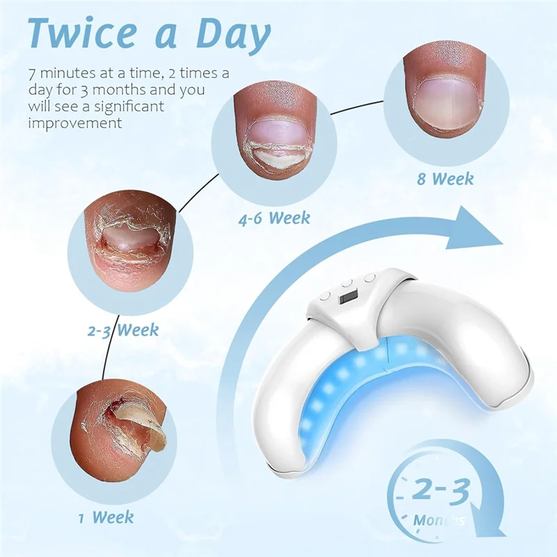 ปากกา A74G-Lunavia สำหรับรักษาเชื้อราที่เล็บเท้า  รักษาเชื้อราที่เล็บเท้า อุปกรณ์รักษาเชื้อราที่เล็บ