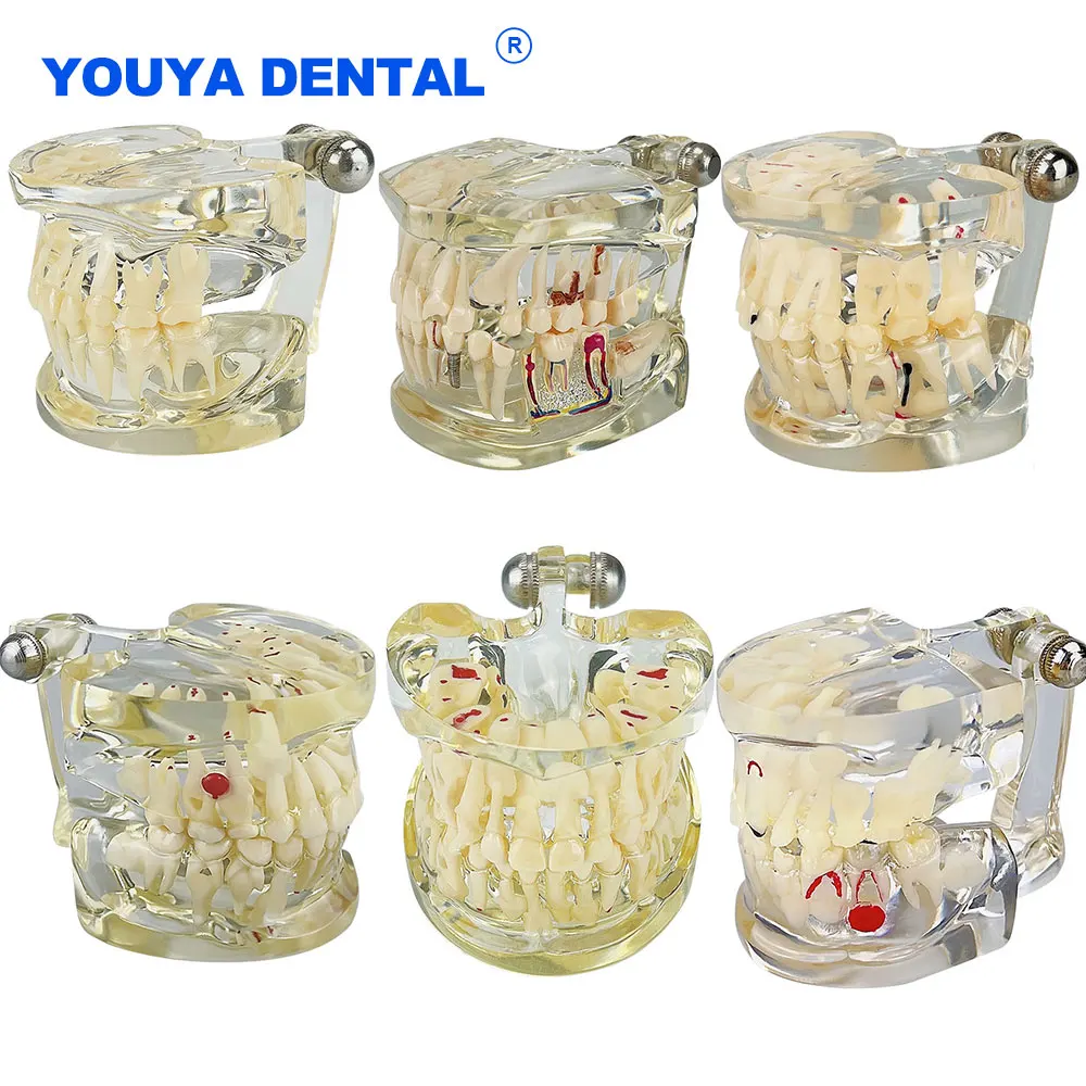 

Multiple Dental Teeth Model Children'S Primary Pathological Treatment Model For Practice Teaching Studying Dentistry Pathology