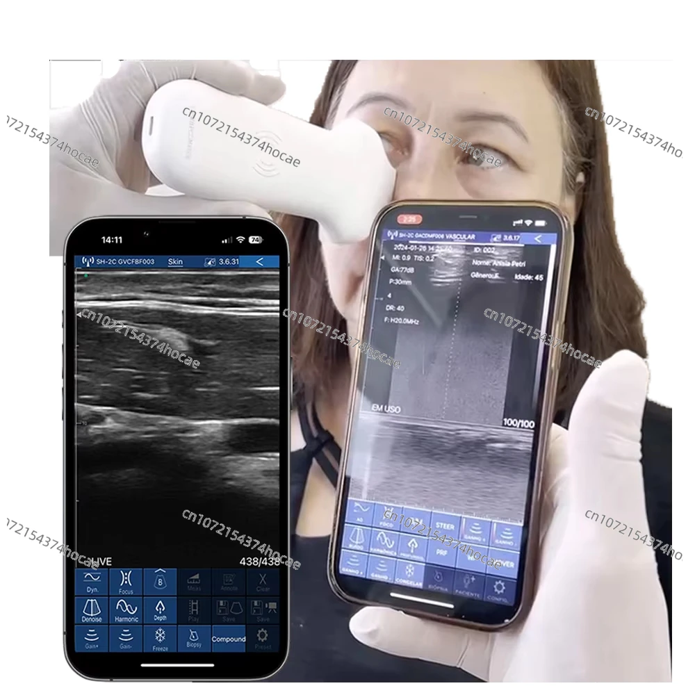 High-resolution wireless handheld ultrasound 16/20MHz for dermal filler injection and implant monitoring