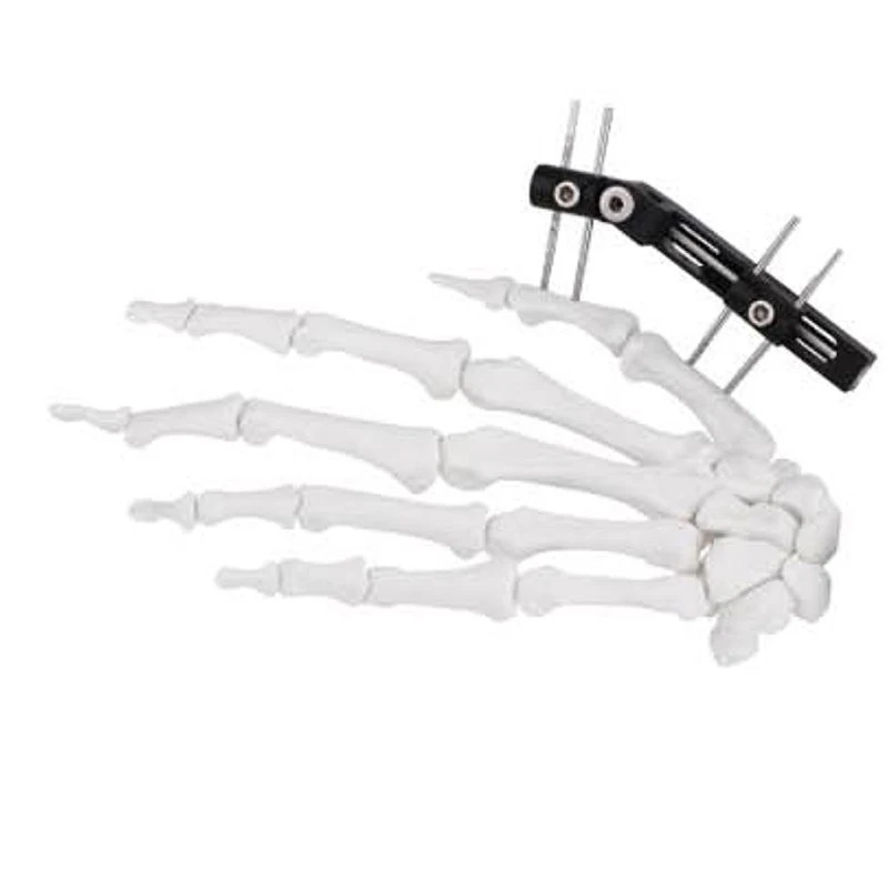 

Factory Direct Sale Finger and Palm Orthopedic External Fixation High Quality Finger External Fixator
