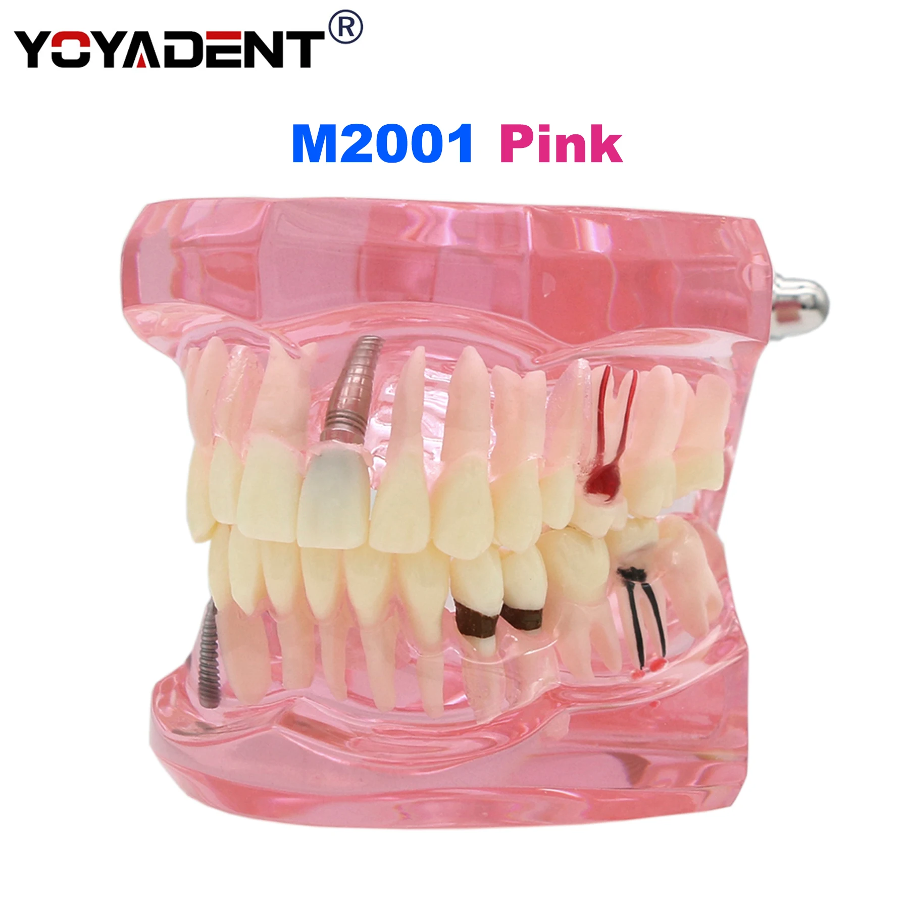 Dental Teeth Model Teaching Model Implant Disease Teeth Repair Restoration Bridge for Dentist Teaching Studying Demo M2001 Pink.