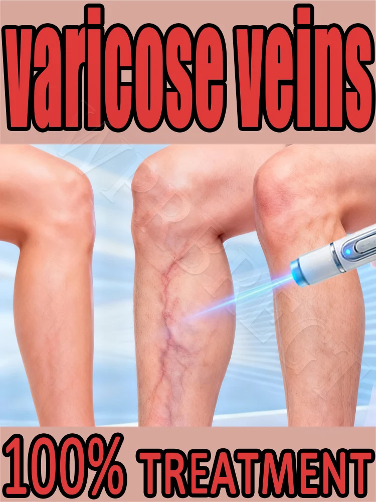 

Painless treatment of spider veins and varicose veins with laser therapy. New generation of venous laser pen