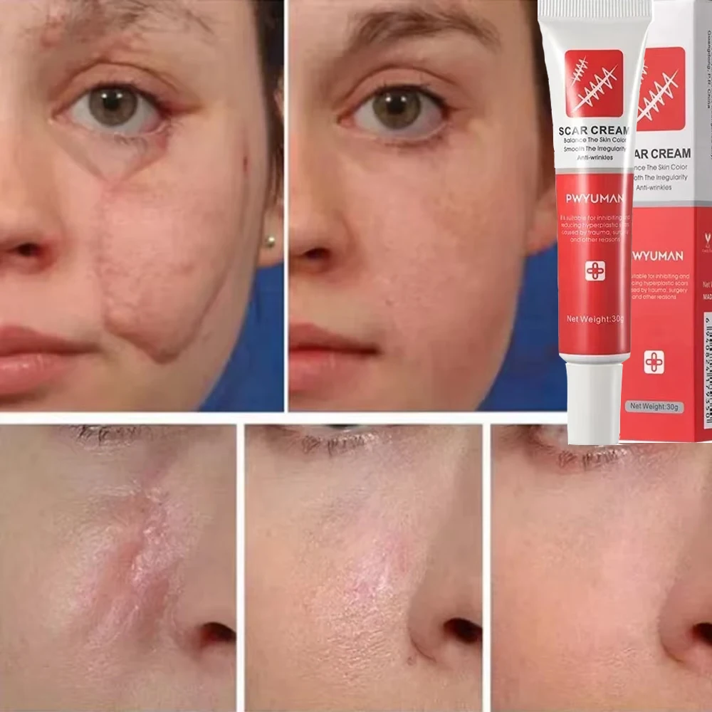 Scar Removal Cream Effective Stretch Marks Burn Surgical Scars Treatment Ointment Acne Spot Moisturizing Repair Body Skin Care