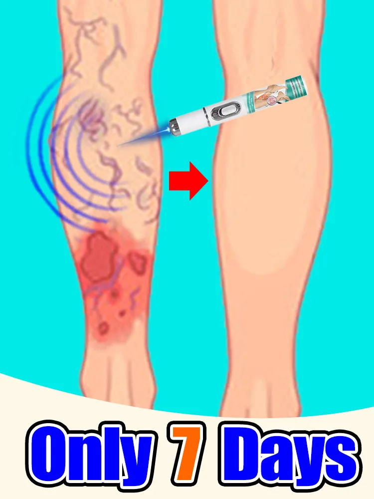 

Blue light vein therapy Say bye to vasculitis, phlebitis, spider leg pain, varicose veins