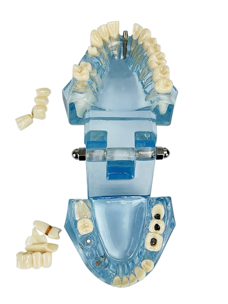

Teeth Repair Model Disease Dental Implant Restoration Bridge Study Model Dentist Demonstration Models For Patient Education