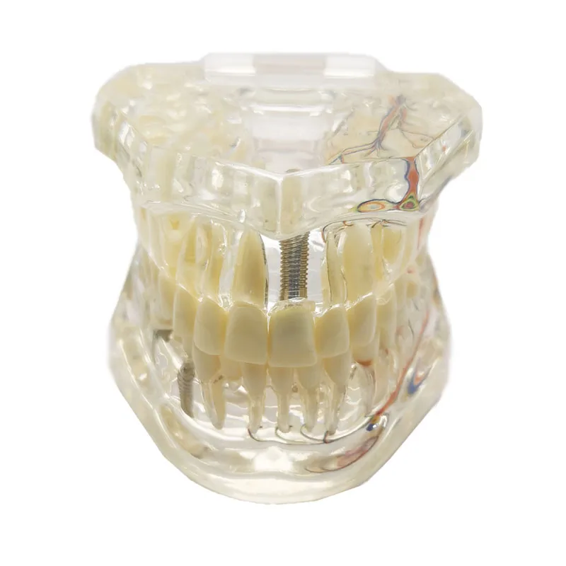 Dental Implant Model Teeth Neural Repair Resin Models Of Diseased Teeth for Dentist  Teaching and Research In Dental Diseases