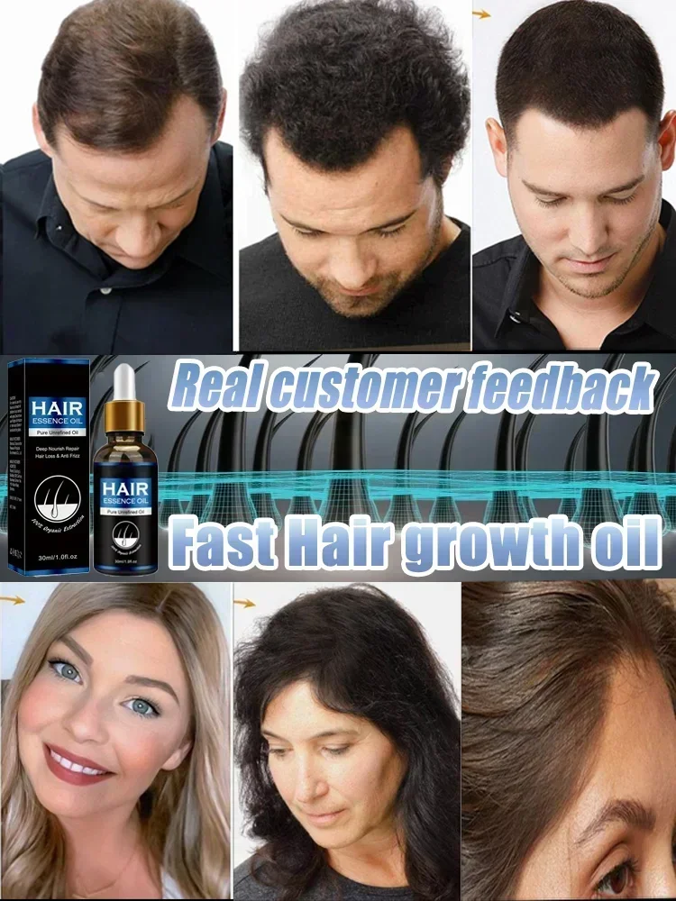 Productos de aceite para el crecimiento rápido del cabello para hombres y mujeres, reparación eficaz de la calvicie, tratamiento anticaída del cabello