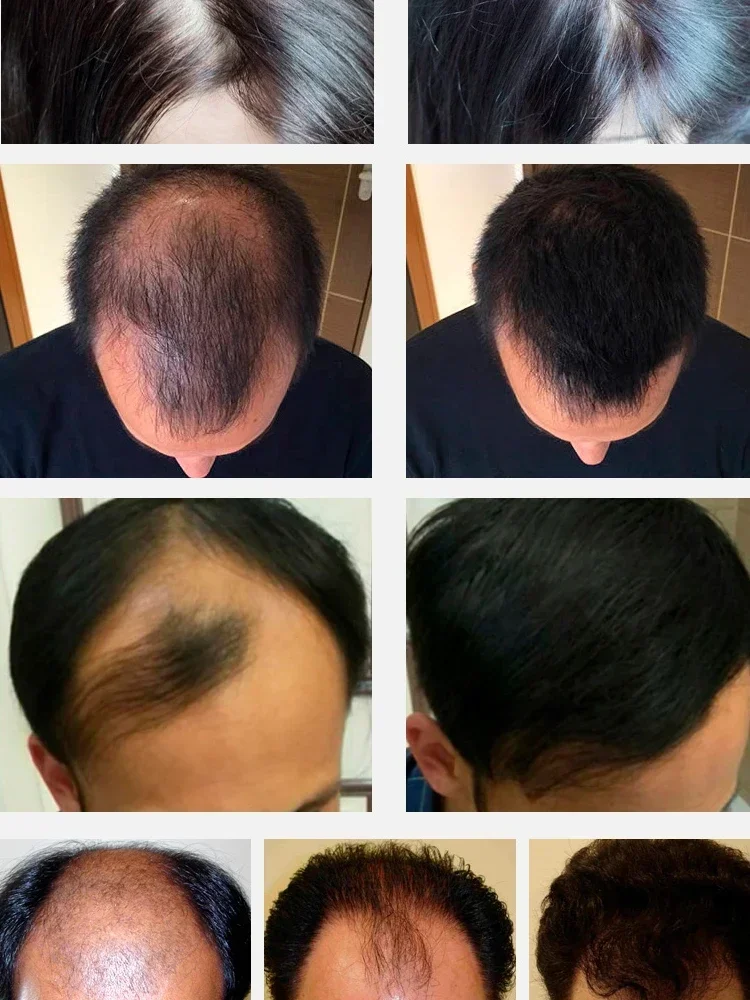 Fast Hair Growth Hair Growth Oil Effective Baldness Repair Hereditary Hair Loss Postpartum