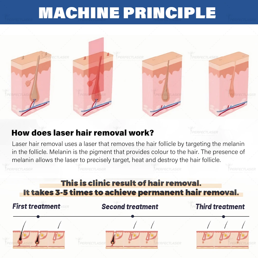 เครื่องกําจัดขนด้วยเลเซอร์ไดโอด Perfectlaser 3 ความยาวคลื่นร่างกายใบหน้าไม่เจ็บปวดน้ําแข็งกําจัดขนเครื่องวิเคราะห์ผิวเครื่องมืออาชีพ