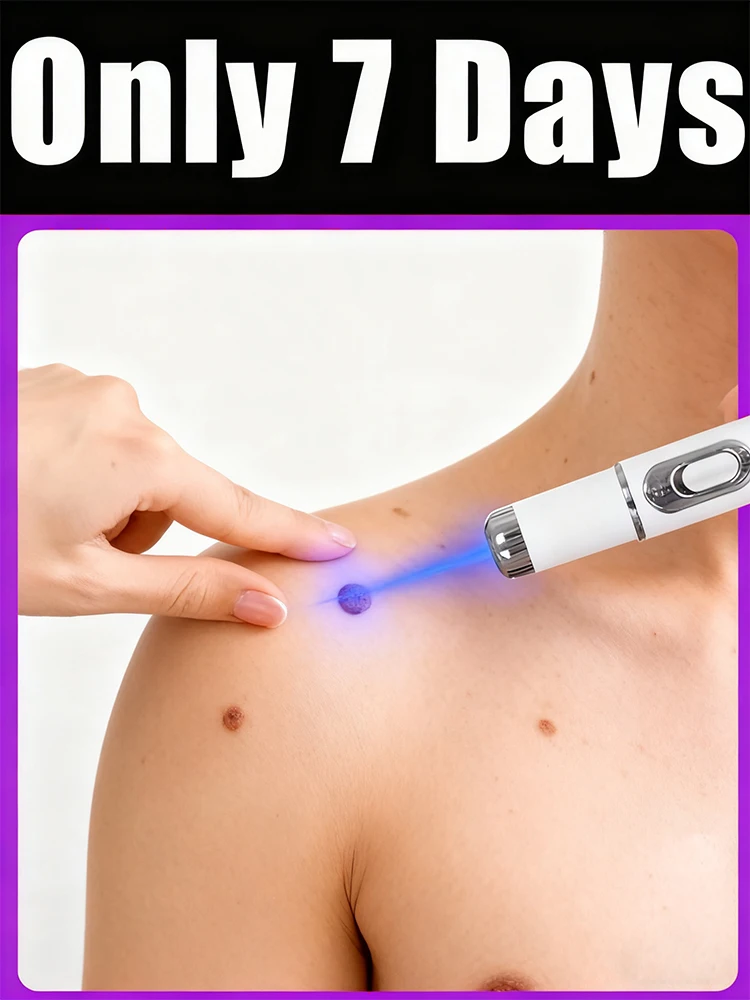 Verruche améliorée de 2e génération réparer la racine des verrues uickly