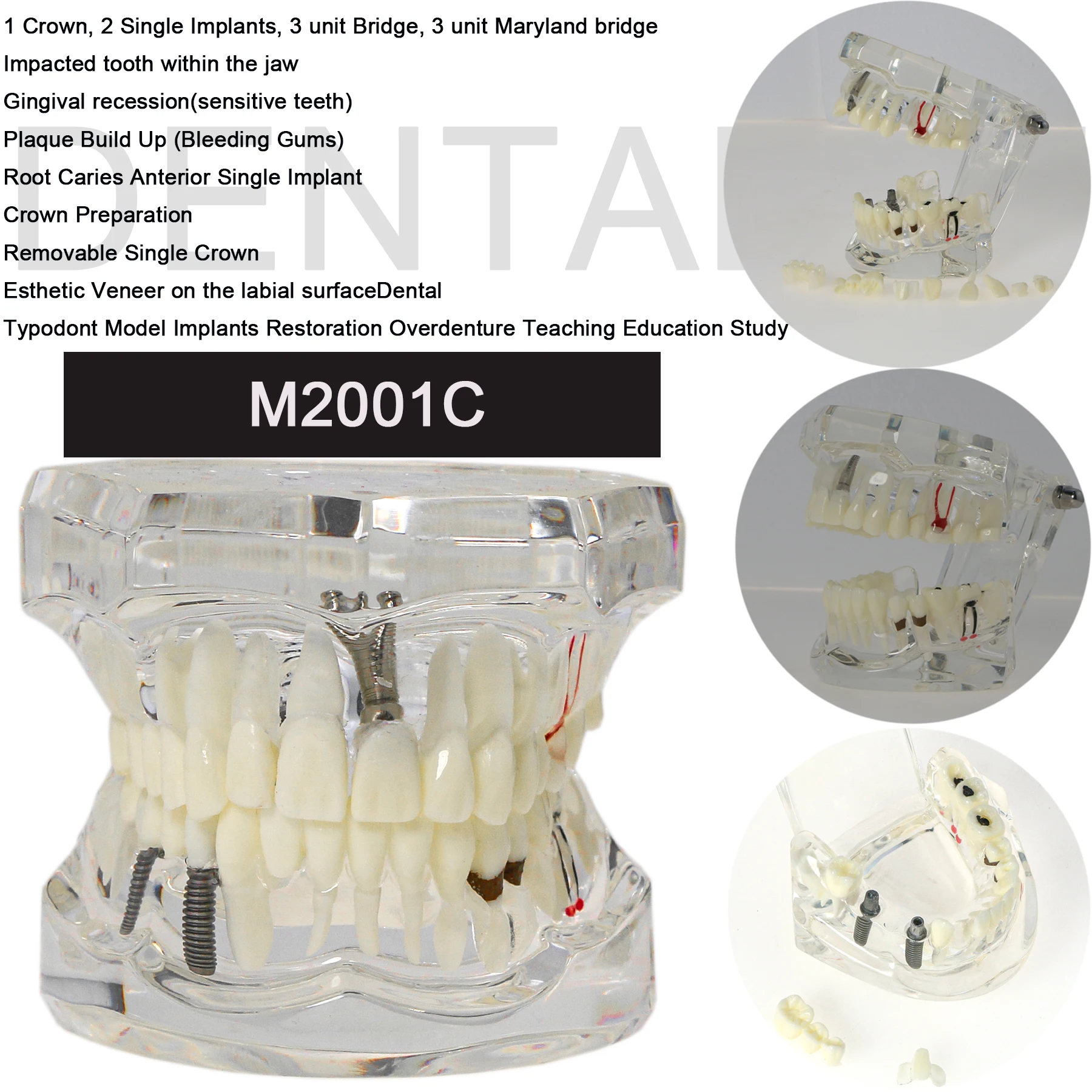 

Dental Typodont Teeth Model Teach Study Oral Implant Restoration Pathology M2001C 1PC