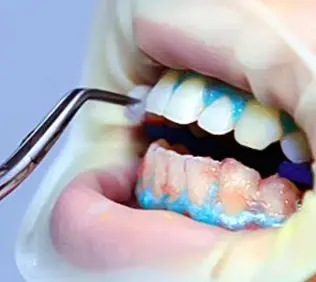 

3Pcs Dental Hygiene Tool Kit for Teeth Cleaning Tartar Scraper Scaler Plaque and Calculus Remover Oral Care Instruments