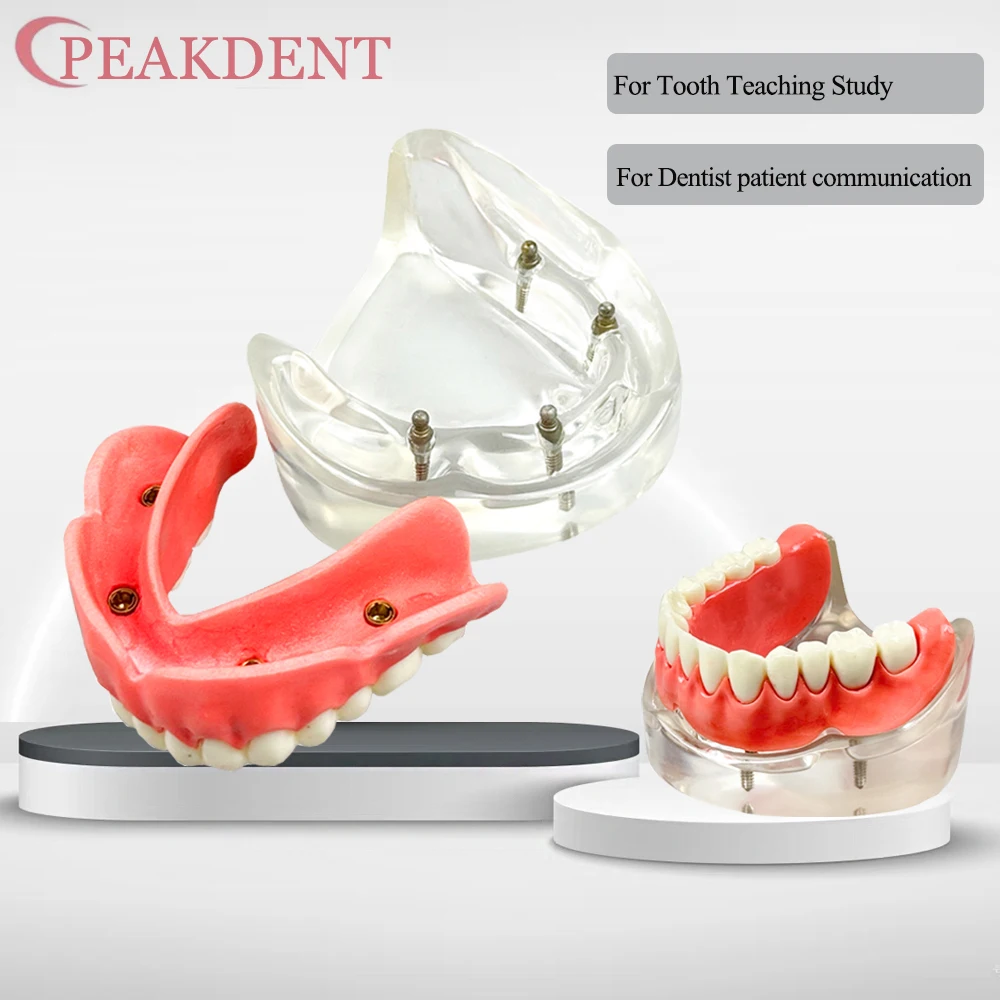 

Dental Upper/Lower Tooth Implant Model Overdenture Teeth Model Removable 4 Implant Model for Dentist Teaching Studying