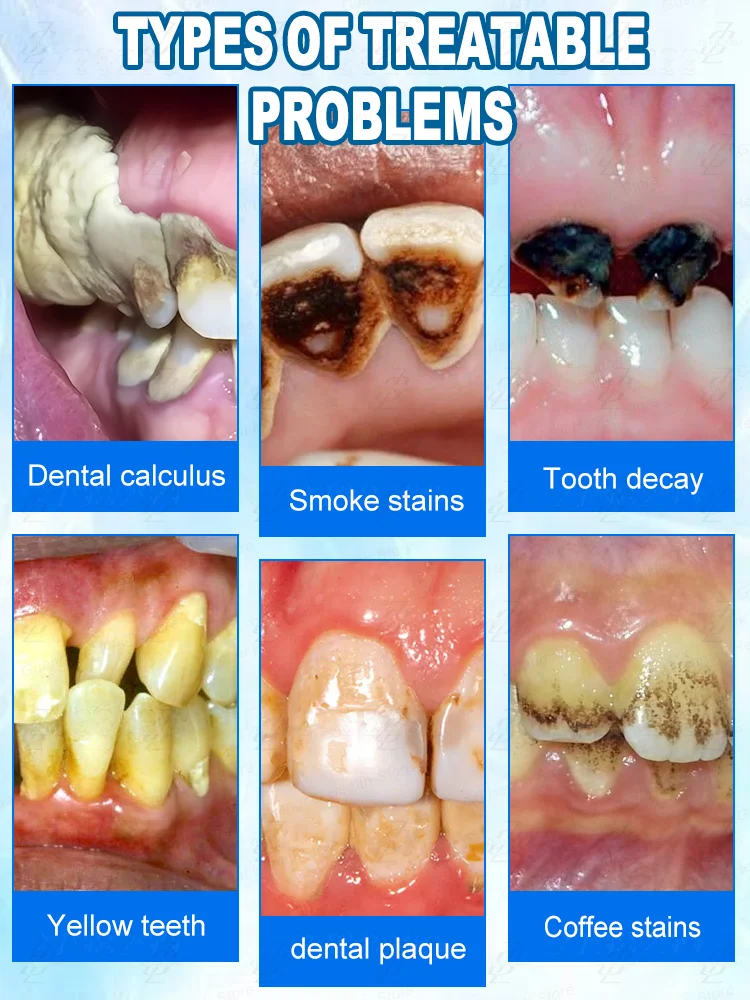 Profesjonalny proszek do wybielania zębów, szybko wybiela zęby i usuwa osad.