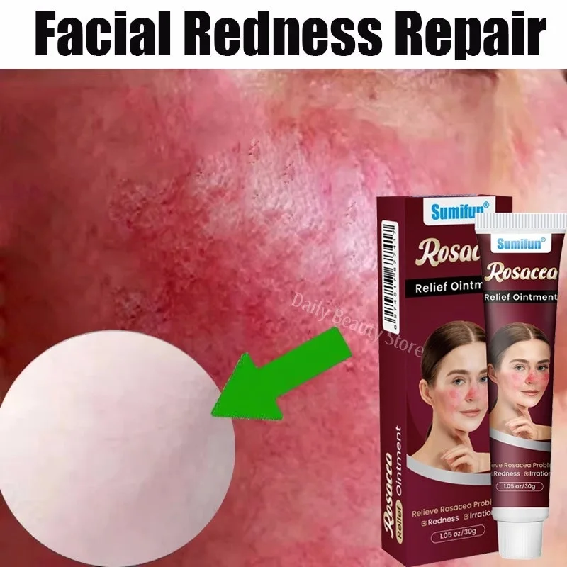 

Repair Facial Redness Cream Instant Spider Vein Remove Sensitive Skin Sooth Anti Redness Rosacea Treat Lotion Korean Cosmetics