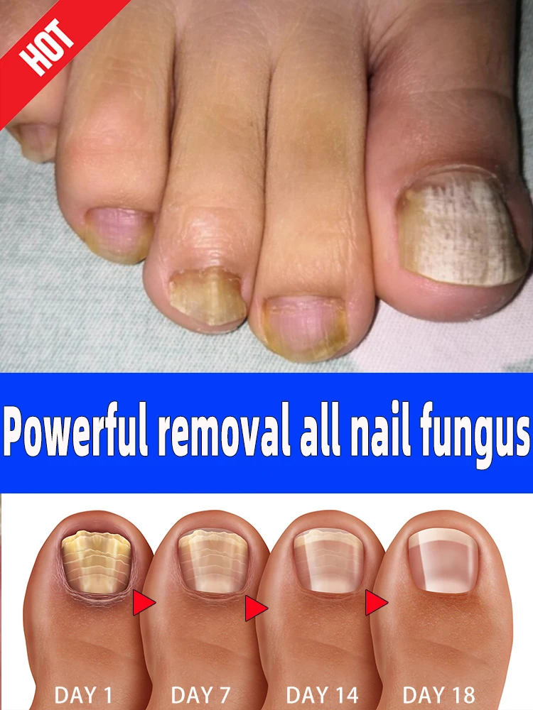 

NewFungal Nail Treatment Foot Nail Fungus Removal Repair Gel Anti Infection Paronychia Onychomycosis Foot Nails Care Esse