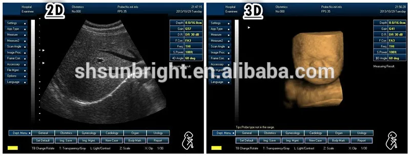 Digital used in hospitgal professional ob gyn vascular 3d ultrasound machine